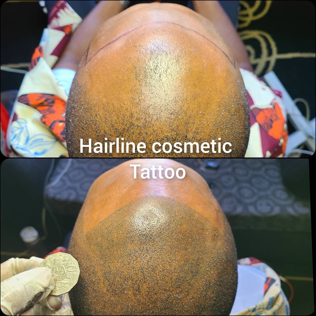 before after hairline